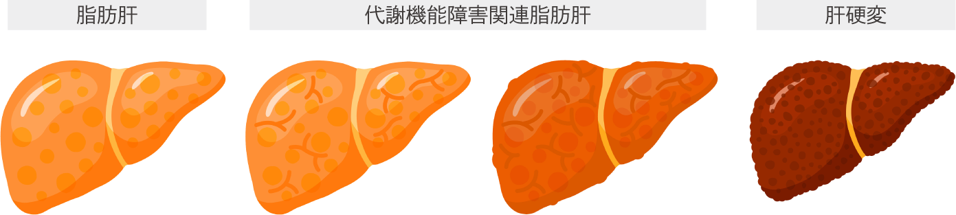 肝臓病・脂肪肝外来 肝臓病・脂肪肝外来